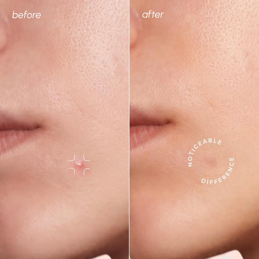 Maree Invisible Pimple & Acne Patches Build Your Bundle Light Pink