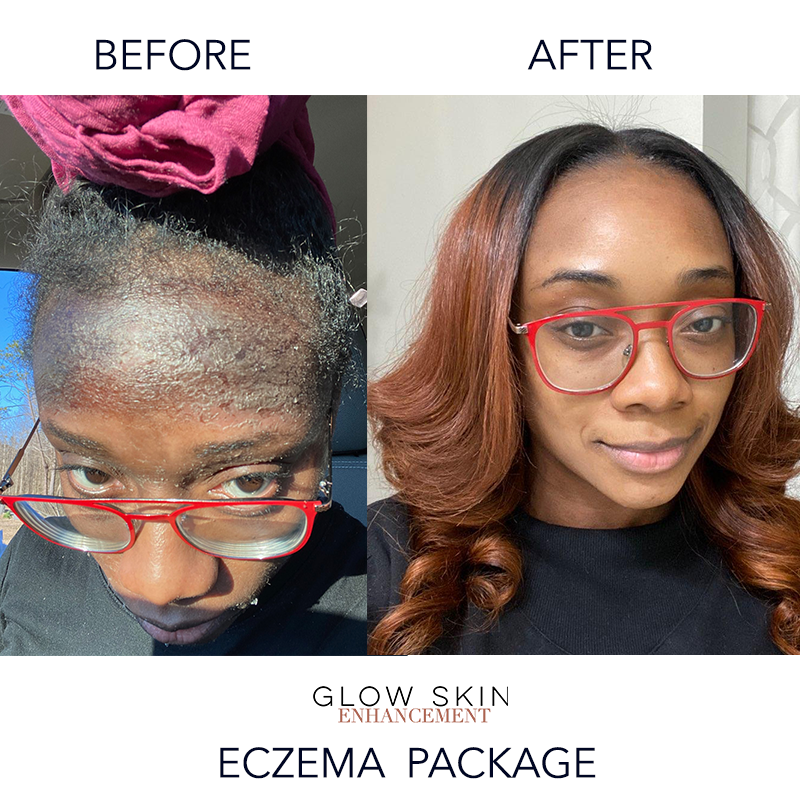 Glow Skin Enhancement ECZEMA RELIEF PACKAGE (Real Results) Eczema Care Dark Slate Gray