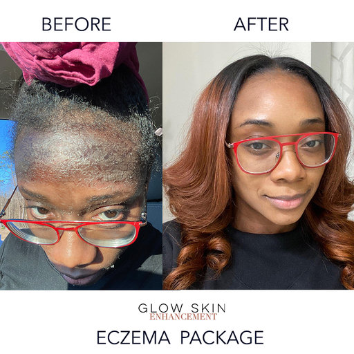 Glow Skin Enhancement ECZEMA RELIEF PACKAGE (Real Results) Eczema Care Dark Slate Gray