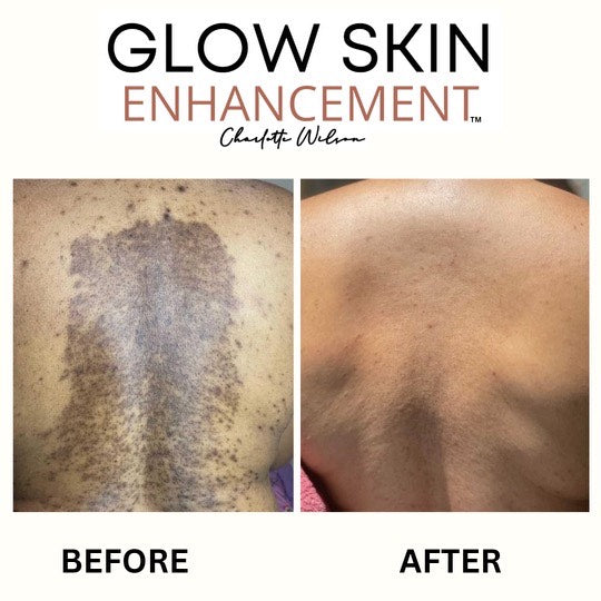 Glow Skin Enhancement ECZEMA RELIEF PACKAGE (Real Results) Eczema Care Rosy Brown