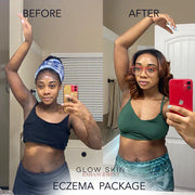 Glow Skin Enhancement ECZEMA RELIEF PACKAGE (Real Results) Eczema Care Rosy Brown