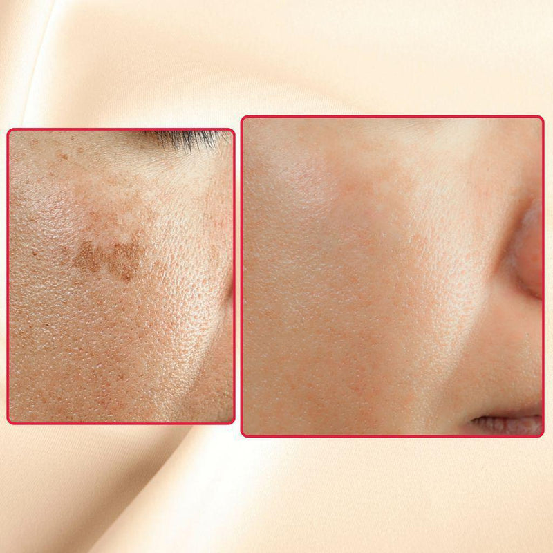 gymsegbë The Eraser Spot Cream | Dark Spot Corrector Dark Spots, Hyperpigmentation Antique White 1 Bottle,2 Bottles Save $5.99,3 Bottles Save $9.98,4 Bottles Save $12.97
