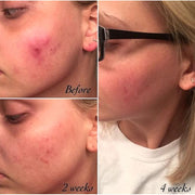 Timeless Organics Skin Care 3-Step Acne System Kit Light Coral Gel,Foaming