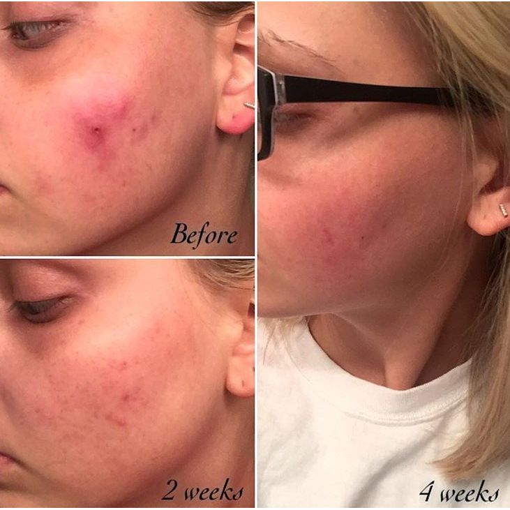 Timeless Organics Skin Care 3-Step Acne System Kit Light Coral Gel,Foaming