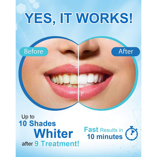 MySmile Teeth Whitening Pen w/ 35%CP Teeth Whitening White Smoke