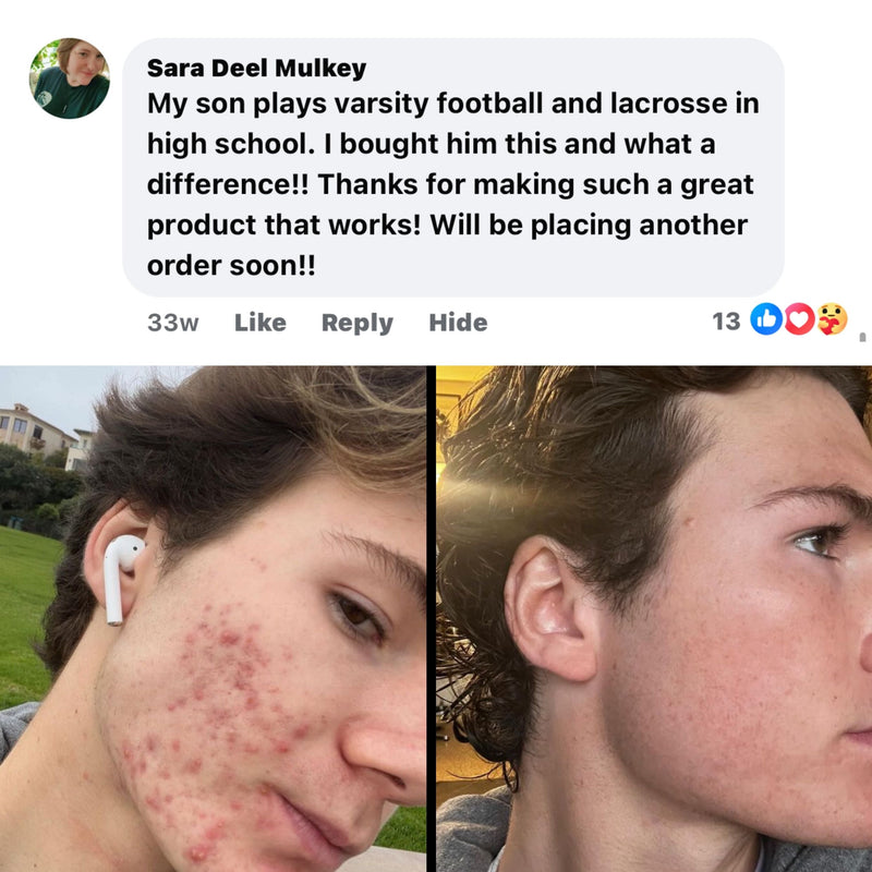 BALLBOYZ MVP Face Acne Scrubs White Smoke Ballboyz Activated Charcoal (Severe Acne),Ballboyz Coconut Cove (Medium Acne),Ballboyz Lemonade (Light Acne),Ballgirlz Black Diamond (Severe Acne),Ballgirlz Beach Bliss (Medium Acne),Ballgirlz Strawberry Lemonade (Light Acne)