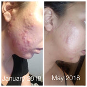 Butter Me Up Organics Super Acne Fighter / Organic Acne Treatment / Acne / Essential Oils / Natural  Acne Treatment / Acne Scars / Hormonal Acne / Cystic Acne Face Rosy Brown