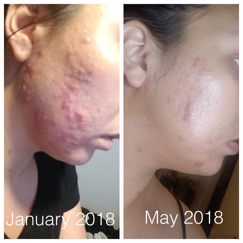 Butter Me Up Organics Super Acne Fighter / Organic Acne Treatment / Acne / Essential Oils / Natural  Acne Treatment / Acne Scars / Hormonal Acne / Cystic Acne Face Rosy Brown