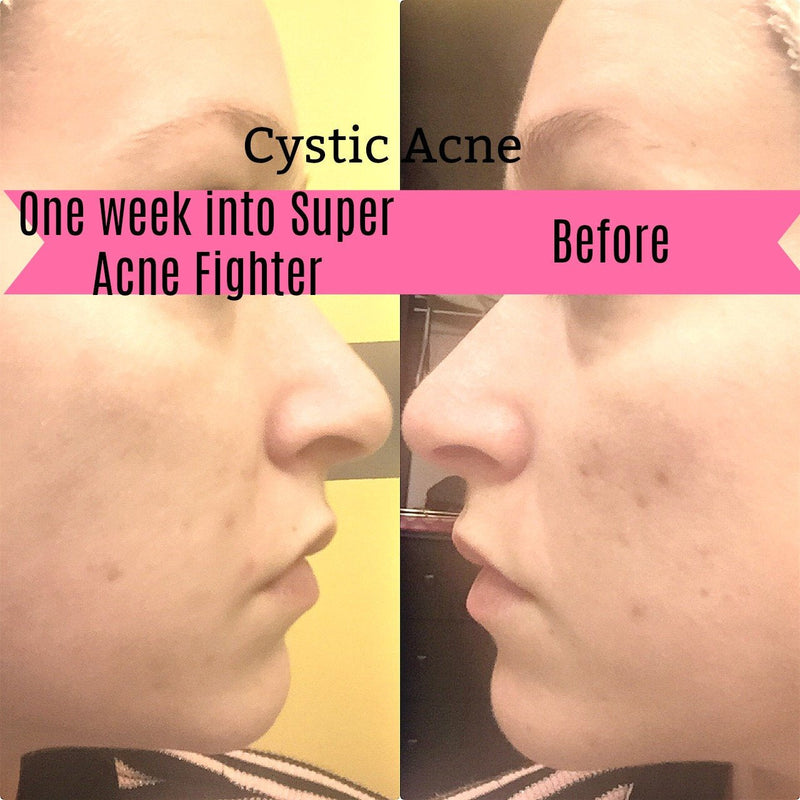 Butter Me Up Organics Super Acne Fighter / Organic Acne Treatment / Acne / Essential Oils / Natural  Acne Treatment / Acne Scars / Hormonal Acne / Cystic Acne Face Tan