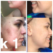 Butter Me Up Organics Super Acne Fighter / Organic Acne Treatment / Acne / Essential Oils / Natural  Acne Treatment / Acne Scars / Hormonal Acne / Cystic Acne Face Rosy Brown