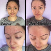 Timeless Organics Skin Care 3-Step Acne System Kit Rosy Brown Gel,Foaming