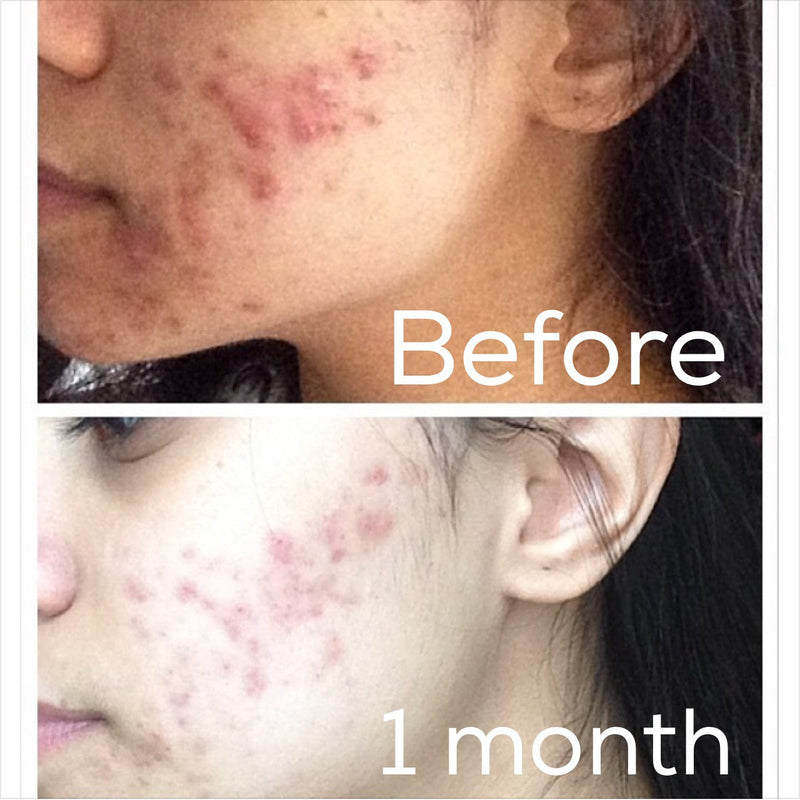 Timeless Organics Skin Care 3-Step Acne System Kit Black Gel,Foaming